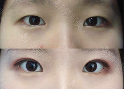 韩国纯真双眼皮手术日记图