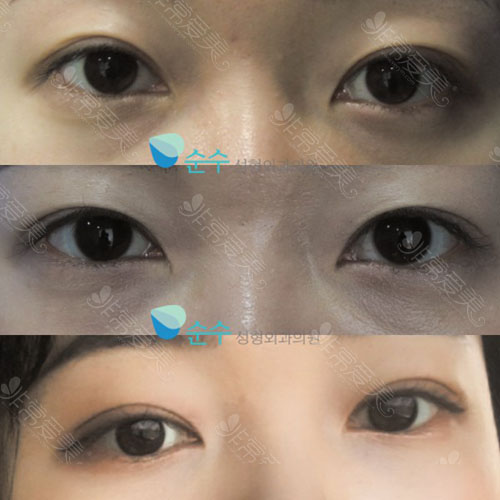 韩国双眼皮手术照片图