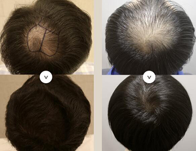 韩国永长毛发移植医院毛发种植前后对比图