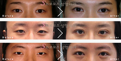 韩国PROPOSE整容外科眼部整形照片