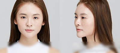 韩国PROPOSE整形面部综合手术术前照片