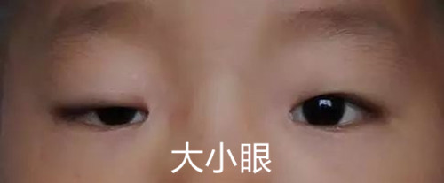 韩国ID大小眼矫正手术案例图片分享，手术容易难度并不高！