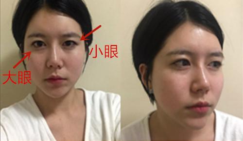 韩国ID大小眼矫正手术案例图片分享，手术容易难度并不高！
