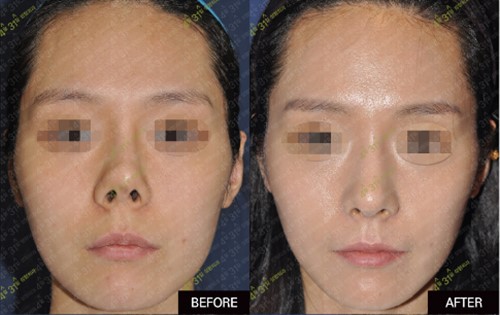 鼻尖短鼻孔外露该怎么修复，韩国40000元修复方案可靠吗？