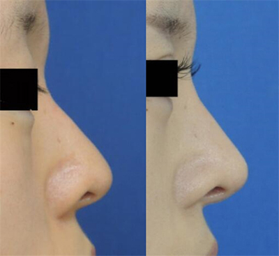 日本银座S美容形成外科鼻部整形照片