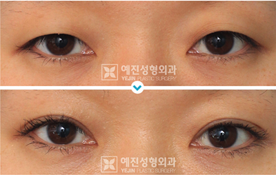 韩国yenjin双眼皮手术对比