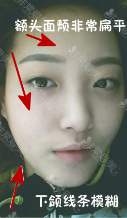 韩国双眼皮手术怎么做