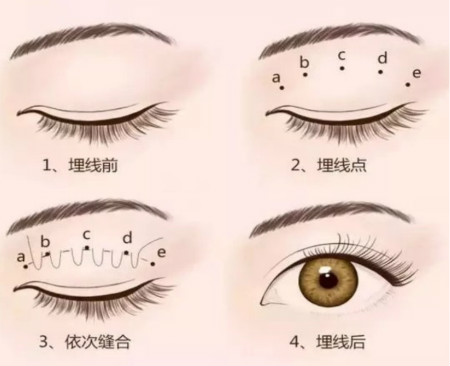 韩国双眼皮手术特色