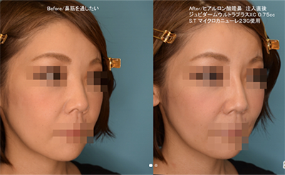 日本Sapho整形医院鼻部整形效果图