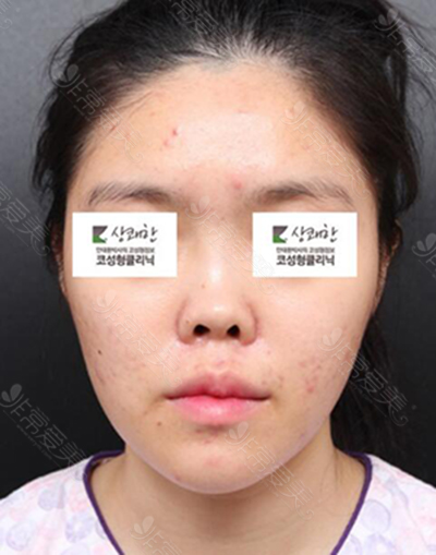 韩国清新整形外科鼻修复术前照片