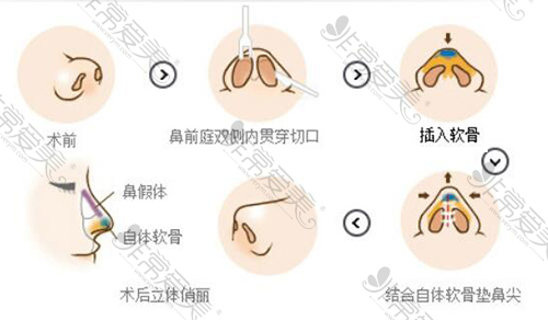 韩国修复挛缩鼻常用哪些方式,三种靠谱修复方法汇总分析！