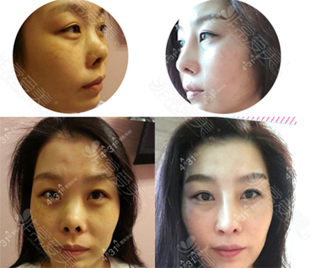 韩国4月31日整形外科挛缩鼻矫正照片