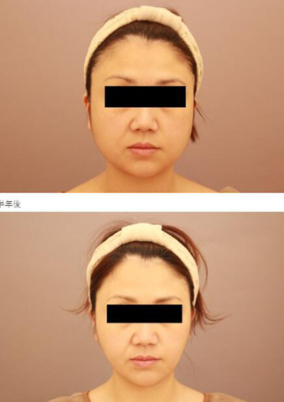 日本Mods Clinic整形外科面部吸脂前后照片