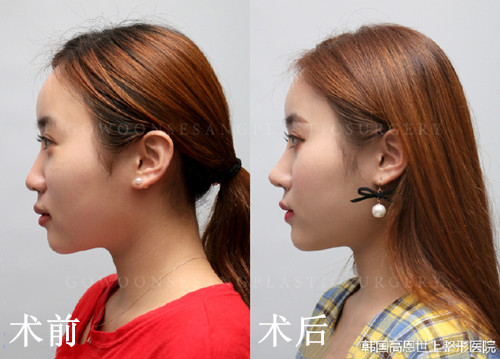李炳浍院长在韩国做鼻子怎么样？鼻小柱萎缩能修复吗？