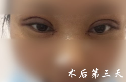 郑倞旻双眼皮手术恢复过程图