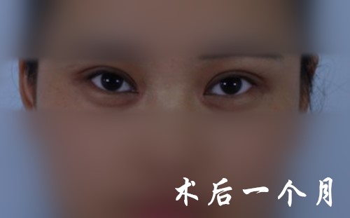 郑倞旻双眼皮手术真人案例图