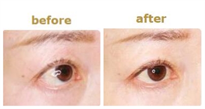 日本MEGA美容整形外科眼部整形前后对比照片
