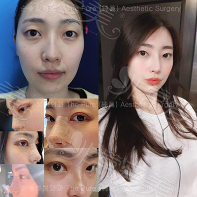 韩国纯真整形外科眼鼻整形案例图