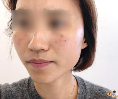 韩国mend整形医院皮肤治疗术前照片