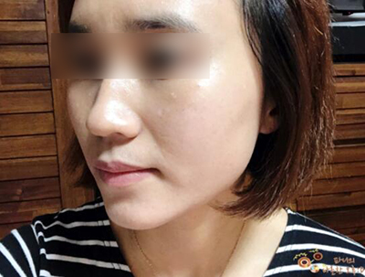 韩国mend整形医院皮肤治疗恢复期照片