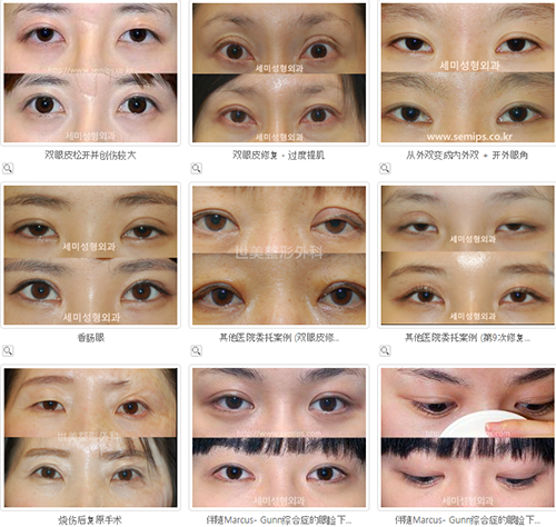韩国SEMI世美整形医院怎么样？眼部修复手术效果如何？