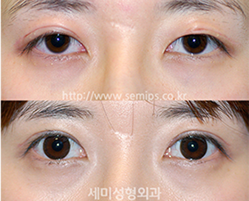 韩国SEMI世美整形医院眼睑下垂修复