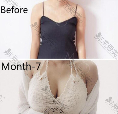 韩国MIGO美高整形外科隆胸前后对比照片