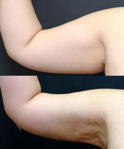 韩国Evita整形医院手臂吸脂前后对比照片