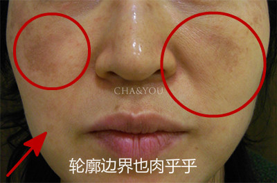 韩国CHA&YOU皮肤科法令纹对比日记