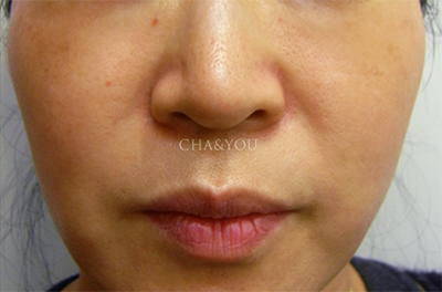 韩国CHA&YOU皮肤科祛斑治疗对比日记