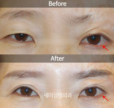 韩国世美整形外科眼部整形前后对比照片
