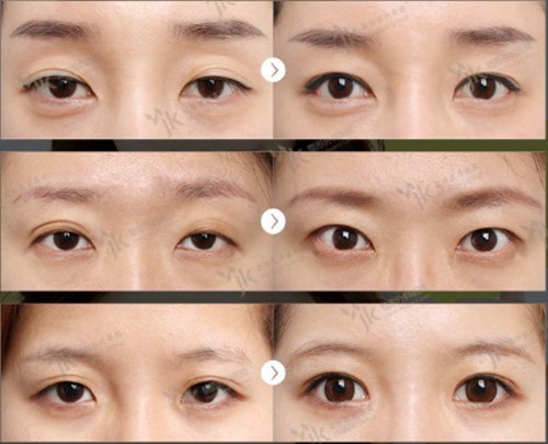 韩国JK整形外科双眼皮案例图