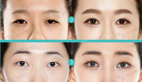 韩国JK整形外科双眼皮案例图