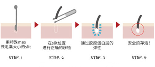 韩国毛发移植医院手术方法图