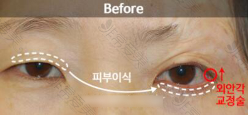 韩国世美整形外科眼修复方法示意图