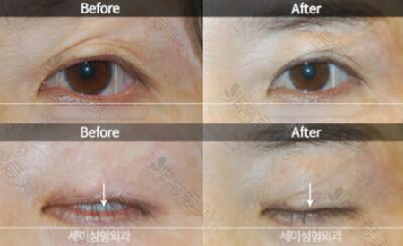 韩国世美整形外科眼修复前后对比案例