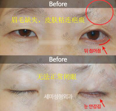 韩国世美整形外科眼修复术前照片
