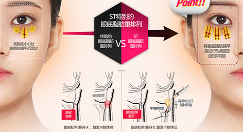 韩国ST整形外科眼袋手术原理图