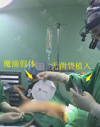 韩国普罗菲耳胸部修复手术照片