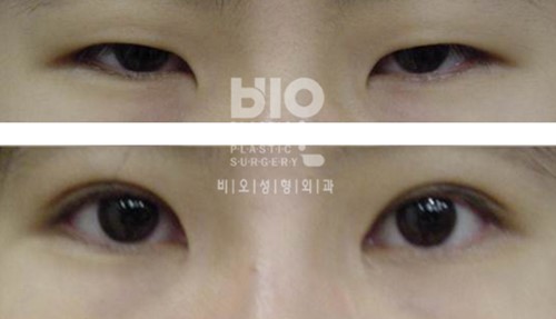韩国BIO眼部整形真人案例图