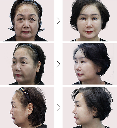 韩国Queenspark整形外科面部除皱手术案例