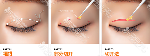 韩国迪美整形医院男性双眼皮手术方法