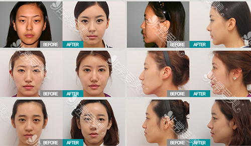 韩国Propose整形外科隆鼻案例
