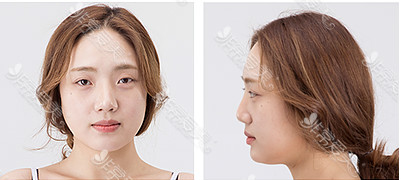韩国Queenspark整形外科鼻手术恢复日记曝光！！！