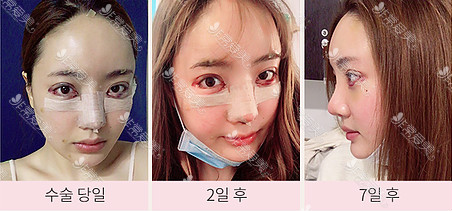 韩国queenspark整形外科鼻手术恢复日记