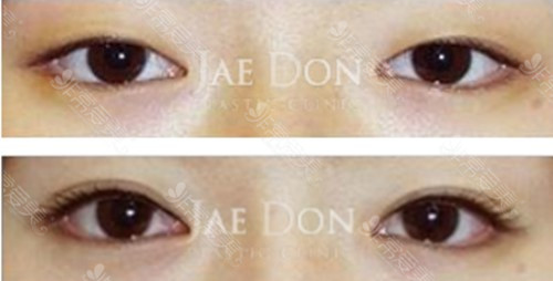 韩国医生徐在敦双眼皮案例图