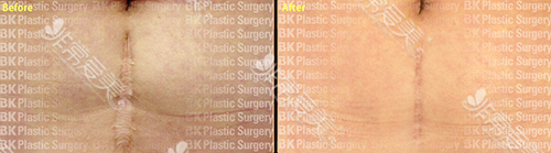 韩国BK整形外科疤痕整形案例图