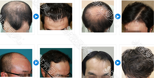 韩国JP整形外科毛发移植案例对比图