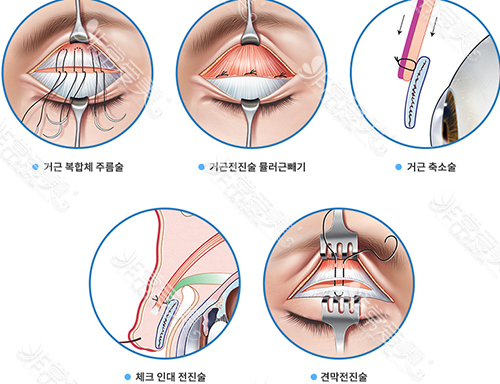 韩国BIO整形外科做上睑下垂手术好吗？日记效果对比明显吗