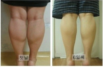 韩国美波瘦脸针瘦小腿案例对比